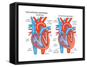 Left Ventricular Hypertrophy-Encyclopaedia Britannica-Framed Stretched Canvas