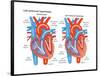 Left Ventricular Hypertrophy-Encyclopaedia Britannica-Framed Poster