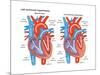 Left Ventricular Hypertrophy-Encyclopaedia Britannica-Mounted Poster