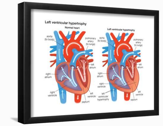 Left Ventricular Hypertrophy-Encyclopaedia Britannica-Framed Poster