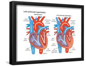 Left Ventricular Hypertrophy-Encyclopaedia Britannica-Framed Poster