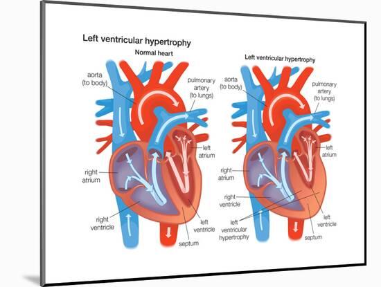 Left Ventricular Hypertrophy-Encyclopaedia Britannica-Mounted Poster