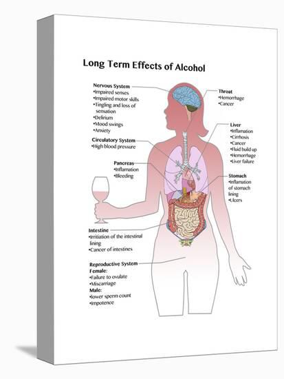 Long Term Effects of Alcohol-Spencer Sutton-Stretched Canvas