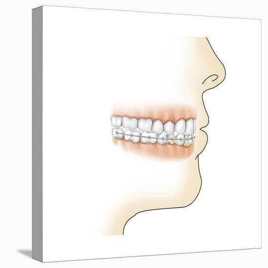 Lower Gums with Braces and Plaque on Teeth-null-Stretched Canvas