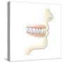 Lower Gums with Braces and Plaque on Teeth-null-Stretched Canvas