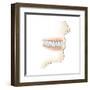 Lower Gums with Braces and Plaque on Teeth-null-Framed Art Print