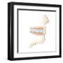 Lower Gums with Braces and Plaque on Teeth-null-Framed Art Print