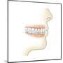 Lower Gums with Braces and Plaque on Teeth-null-Mounted Art Print