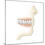 Lower Gums with Braces and Plaque on Teeth-null-Mounted Art Print