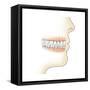 Lower Gums with Braces and Plaque on Teeth-null-Framed Stretched Canvas
