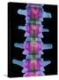 Lumbar Spine, X-ray-Science Photo Library-Stretched Canvas