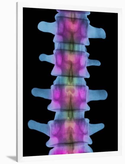 Lumbar Spine, X-ray-Science Photo Library-Framed Photographic Print