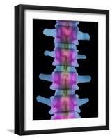 Lumbar Spine, X-ray-Science Photo Library-Framed Photographic Print