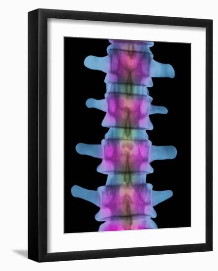 Lumbar Spine, X-ray-Science Photo Library-Framed Photographic Print