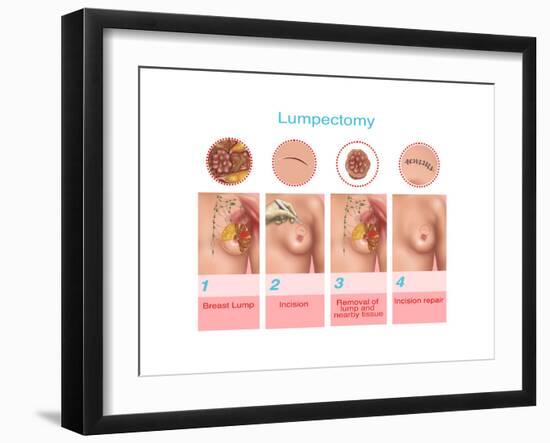 Lumpectomy, Illustration-Gwen Shockey-Framed Art Print