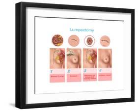 Lumpectomy, Illustration-Gwen Shockey-Framed Art Print
