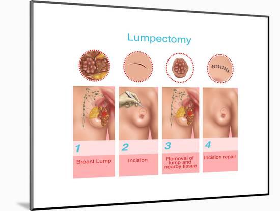 Lumpectomy, Illustration-Gwen Shockey-Mounted Art Print