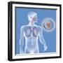 Lung Cancer, Drawing-Caroline Arquevaux-Framed Giclee Print