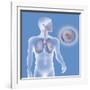 Lung Cancer, Drawing-Caroline Arquevaux-Framed Giclee Print