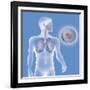 Lung Cancer, Drawing-Caroline Arquevaux-Framed Giclee Print