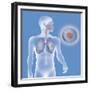 Lung Cancer, Drawing-Caroline Arquevaux-Framed Giclee Print