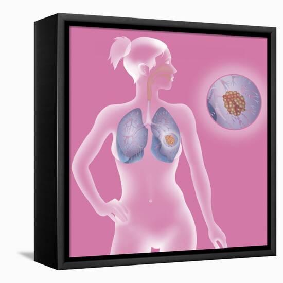 Lung Cancer, Drawing-Caroline Arquevaux-Framed Stretched Canvas