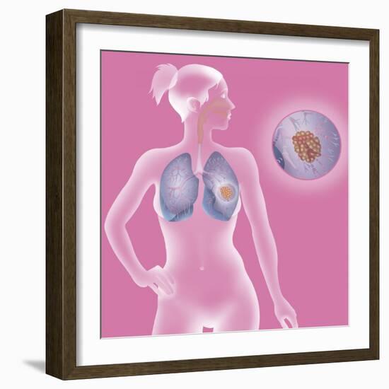 Lung Cancer, Drawing-Caroline Arquevaux-Framed Giclee Print