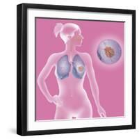 Lung Cancer, Drawing-Caroline Arquevaux-Framed Giclee Print