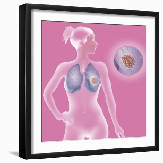 Lung Cancer, Drawing-Caroline Arquevaux-Framed Giclee Print