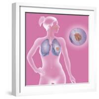 Lung Cancer, Drawing-Caroline Arquevaux-Framed Giclee Print