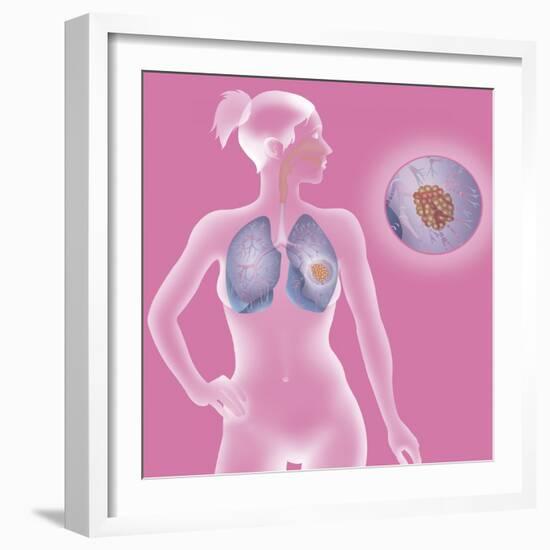 Lung Cancer, Drawing-Caroline Arquevaux-Framed Giclee Print