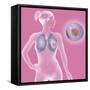 Lung Cancer, Drawing-Caroline Arquevaux-Framed Stretched Canvas