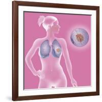 Lung Cancer, Drawing-Caroline Arquevaux-Framed Giclee Print