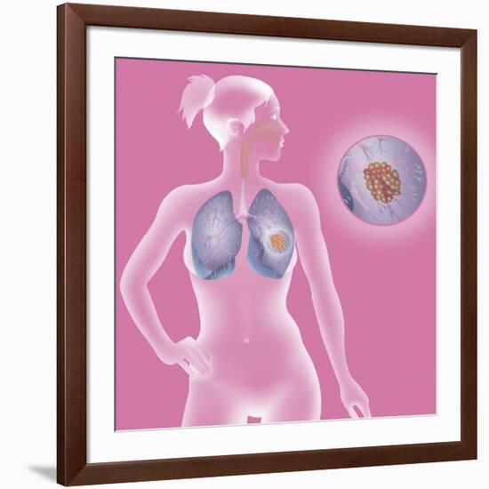 Lung Cancer, Drawing-Caroline Arquevaux-Framed Giclee Print