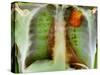 Lung Cancer, X-ray-Du Cane Medical-Stretched Canvas