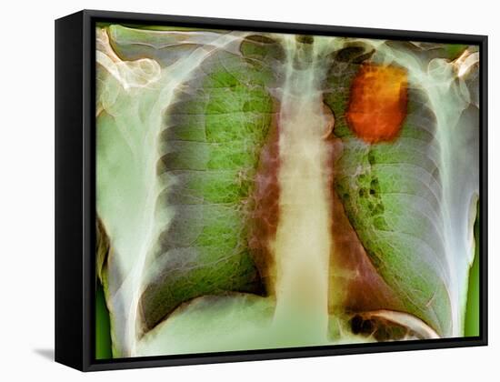 Lung Cancer, X-ray-Du Cane Medical-Framed Stretched Canvas