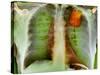 Lung Cancer, X-ray-Du Cane Medical-Stretched Canvas