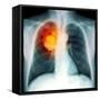 Lung Cancer, X-ray-Du Cane Medical-Framed Stretched Canvas