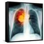 Lung Cancer, X-ray-Du Cane Medical-Framed Stretched Canvas