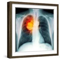 Lung Cancer, X-ray-Du Cane Medical-Framed Premium Photographic Print