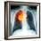 Lung Cancer, X-ray-Du Cane Medical-Framed Premium Photographic Print