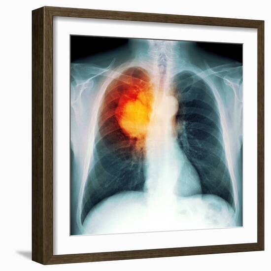 Lung Cancer, X-ray-Du Cane Medical-Framed Premium Photographic Print