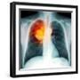 Lung Cancer, X-ray-Du Cane Medical-Framed Premium Photographic Print