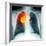 Lung Cancer, X-ray-Du Cane Medical-Framed Premium Photographic Print