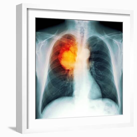 Lung Cancer, X-ray-Du Cane Medical-Framed Premium Photographic Print