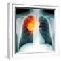 Lung Cancer, X-ray-Du Cane Medical-Framed Premium Photographic Print