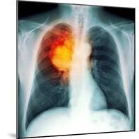 Lung Cancer, X-ray-Du Cane Medical-Mounted Premium Photographic Print