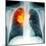 Lung Cancer, X-ray-Du Cane Medical-Mounted Premium Photographic Print