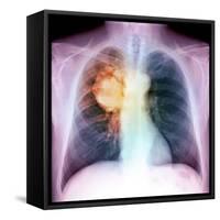 Lung Cancer, X-ray-Du Cane Medical-Framed Stretched Canvas