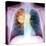 Lung Cancer, X-ray-Du Cane Medical-Stretched Canvas